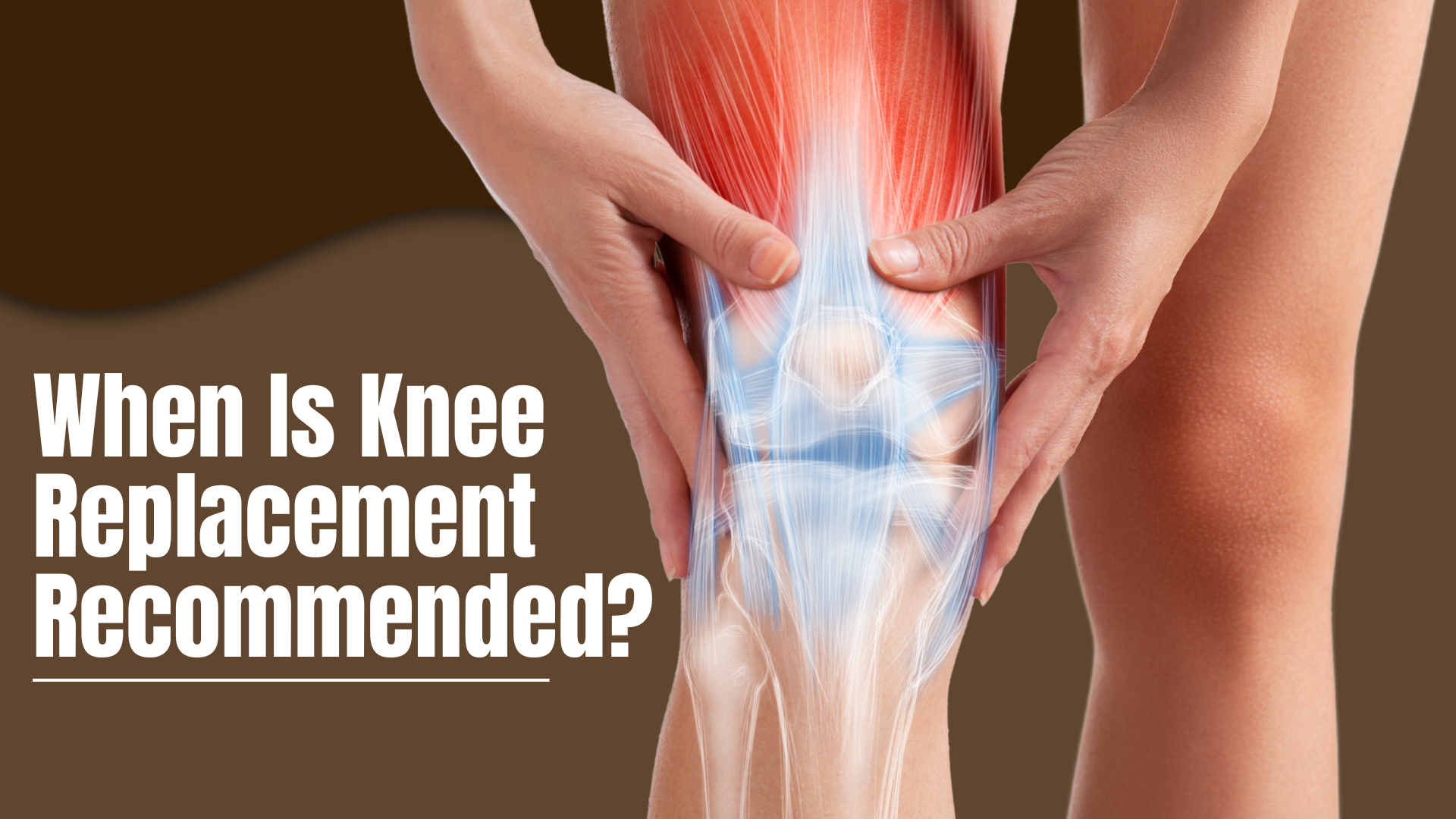 When Is Knee Replacement Recommended?